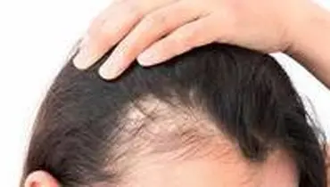 روش های کنترل ریزش موی ارثی