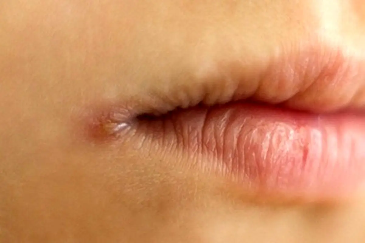 نشانه عفونت قارچی در دهان + راه های درمان