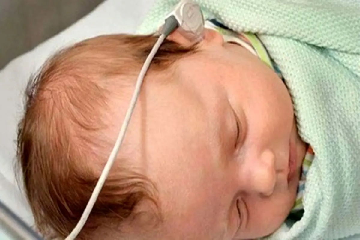 سن طلایی عمل کاشت حلزون شنوایی در نوزادان
