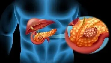 علائم اوليه سرطان لوزالمعده چيست؟