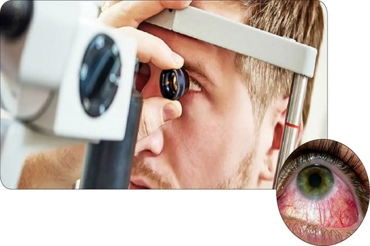 علائم تبخال چشم چیست + روش های درمان