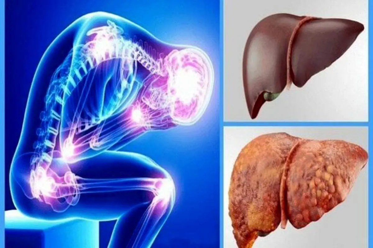 راهکارهای مقابله با کبد چرب
