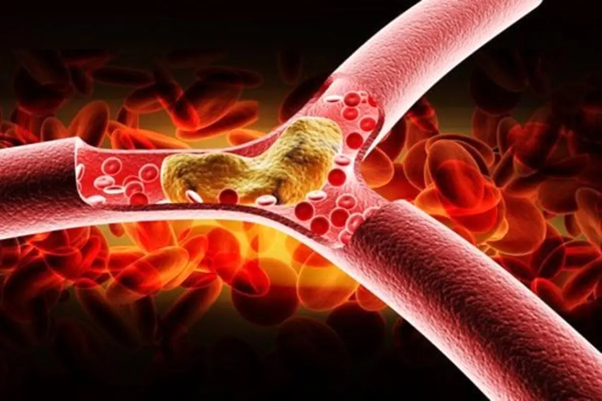 علائم کلسترول خون بالا در بدن