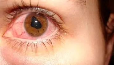 خطرات مالش چشم برای کودکان