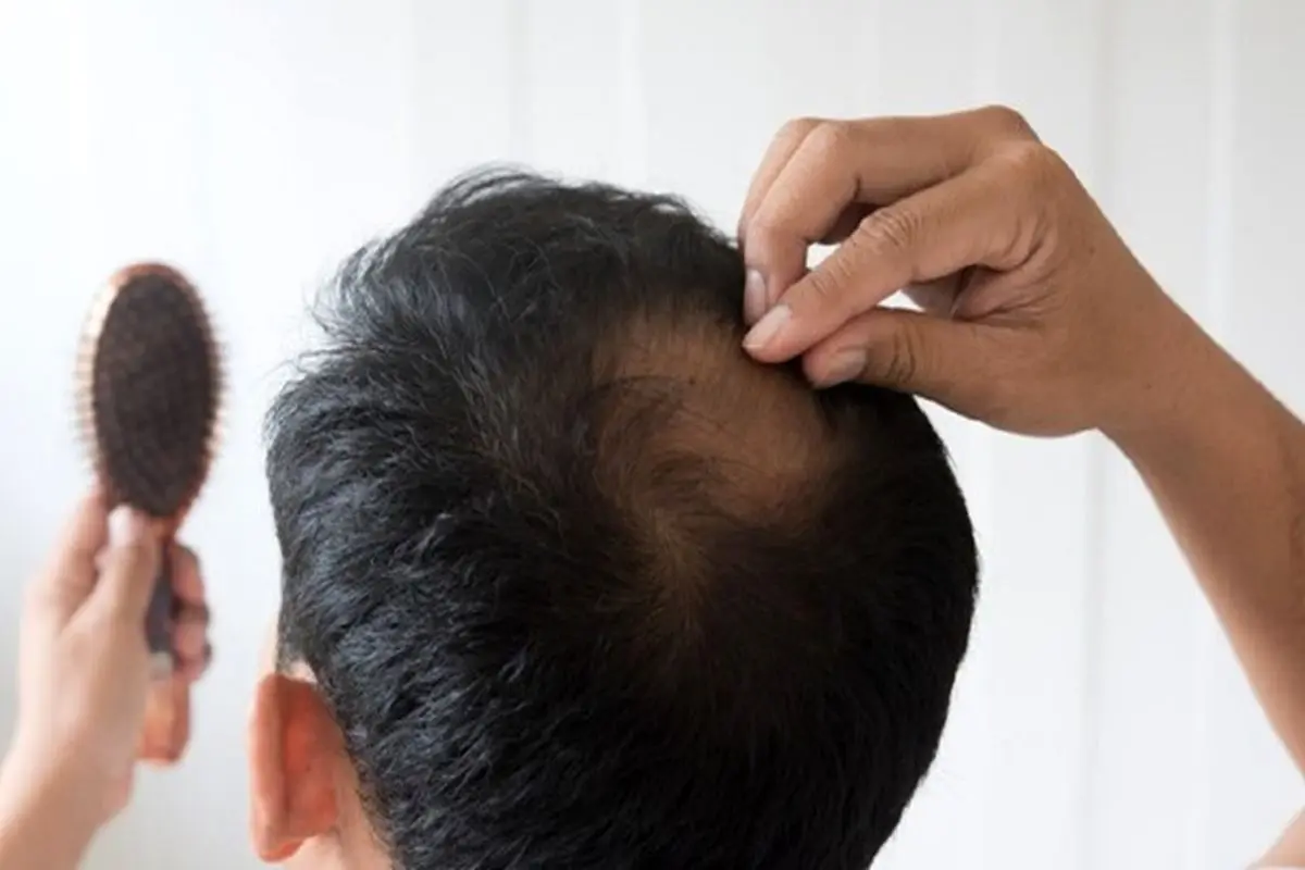 راهکار جدید برای درمان ریزش مو
