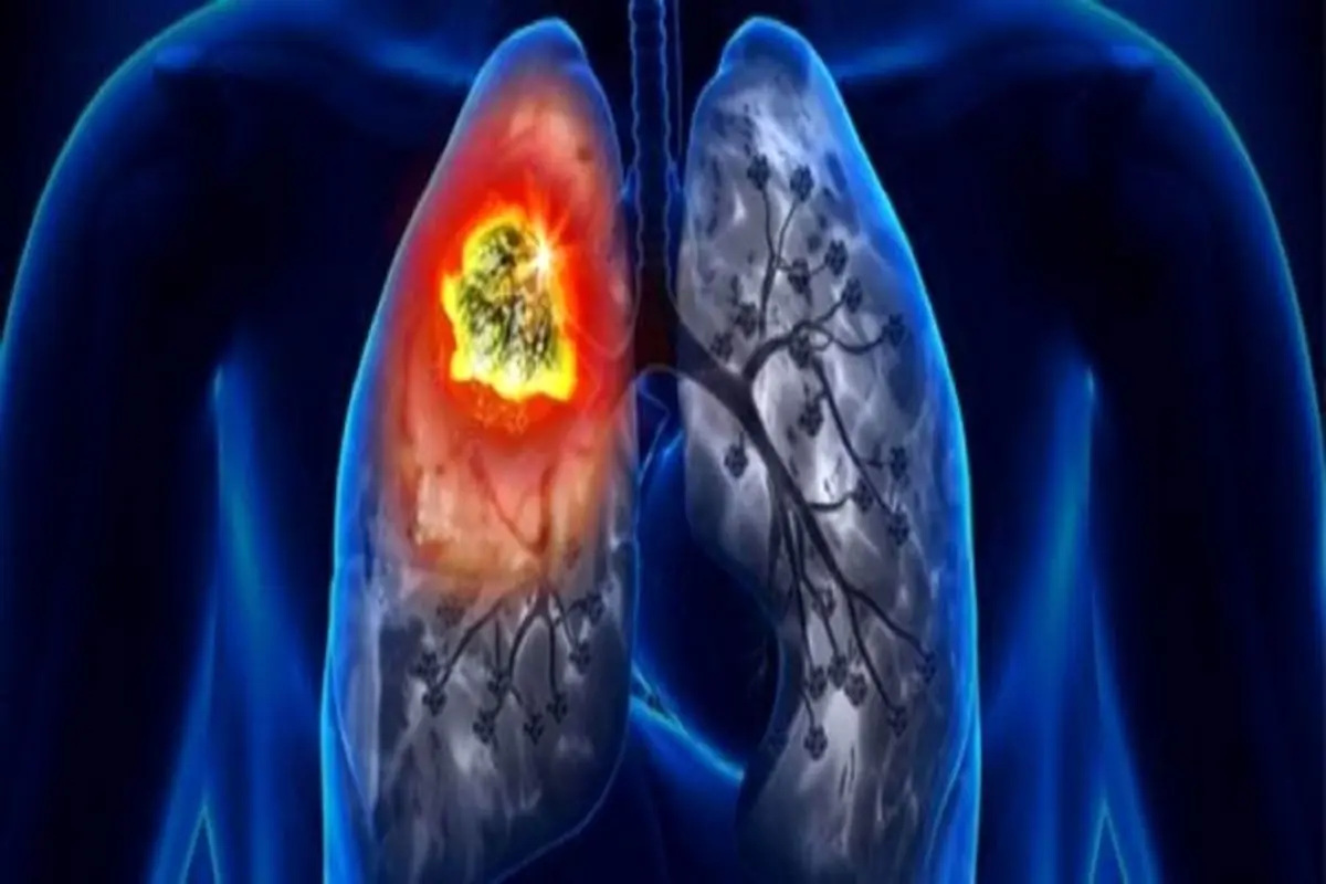 راهی جدید برای شناسایی زودهنگام سرطان ریه