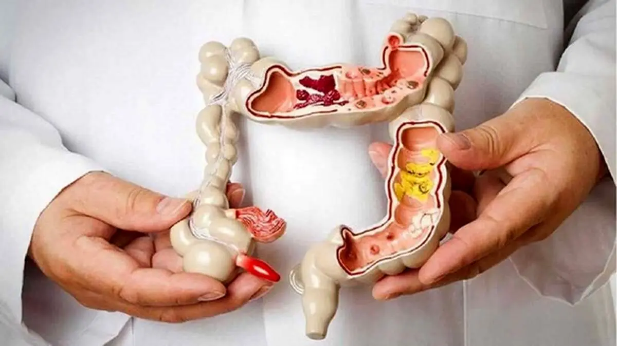 راهکاری ساده برای جلوگیری از ابتلا به سرطان روده