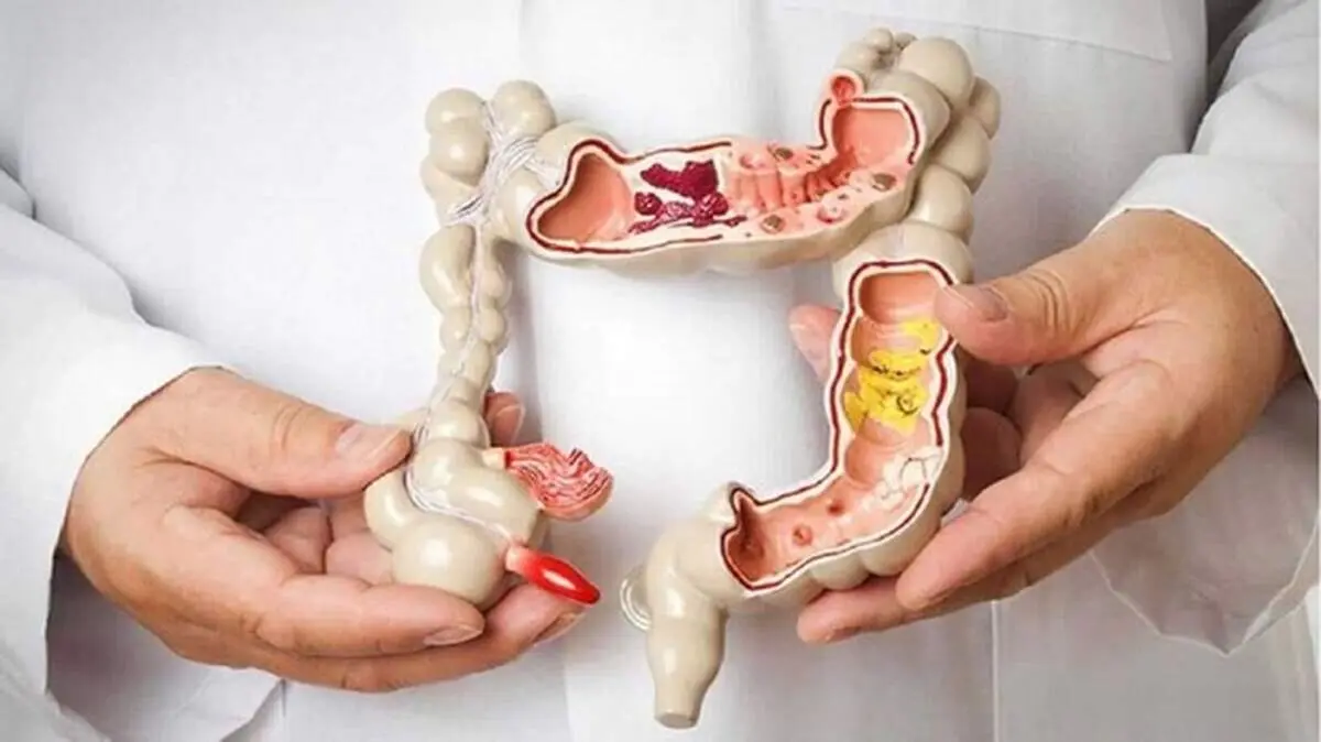 راهکاری ساده برای جلوگیری از ابتلا به سرطان روده