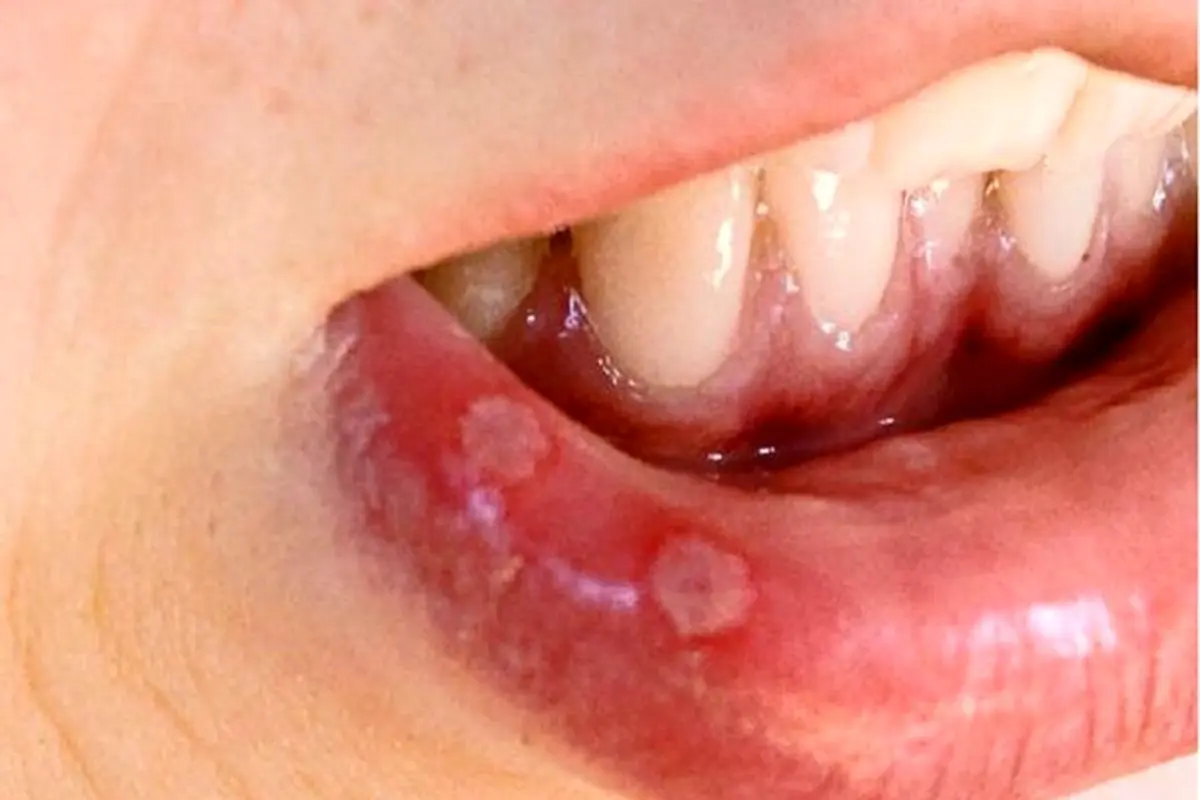 علل زخم های دهانی چیست؟