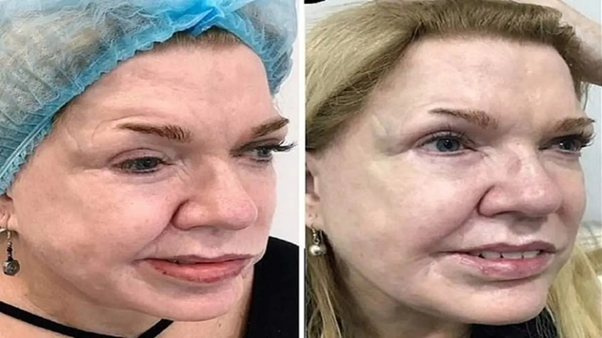 تزریق بوتاکس نقص ۱۹ ساله صورت یک زن را اصلاح کرد + تصاویر