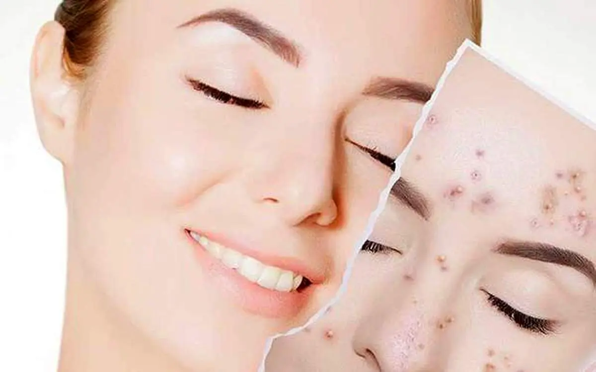 ۵ راهکار ساده برای درمان جوش و آکنه