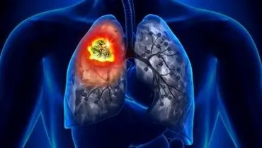 علائم اصلی سرطان ریه چیست؟
