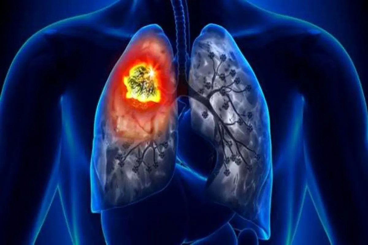 علائم اصلی سرطان ریه چیست؟