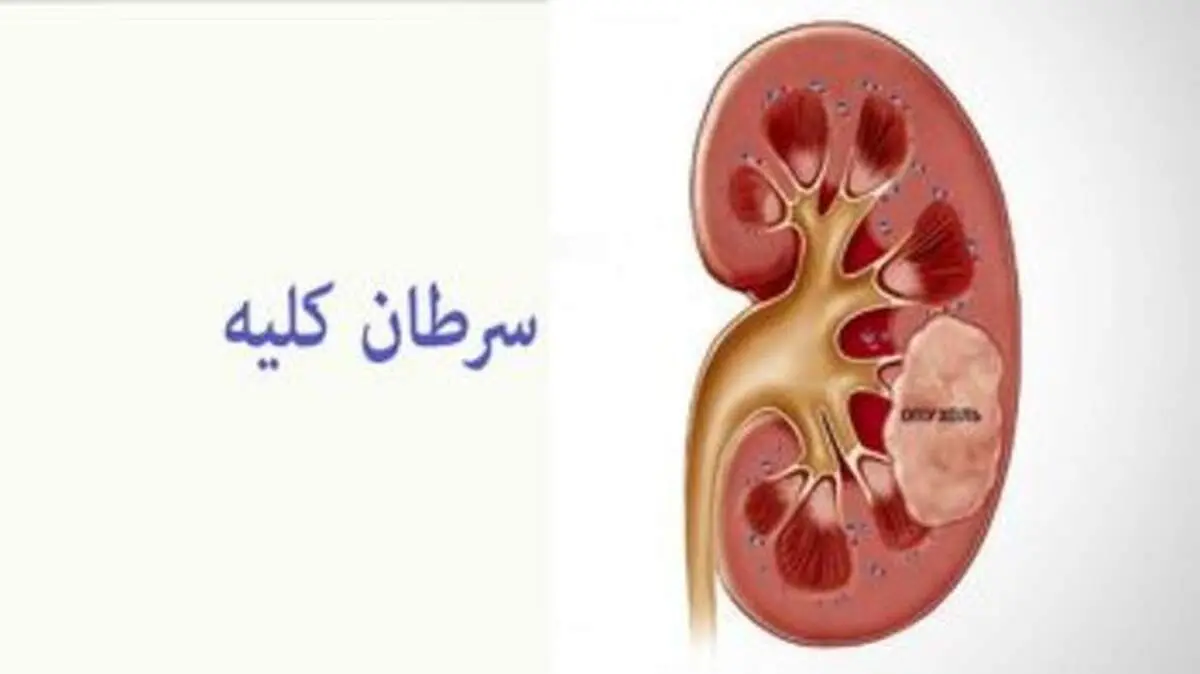 این نشانه‌ها علائم سرطان کلیه است