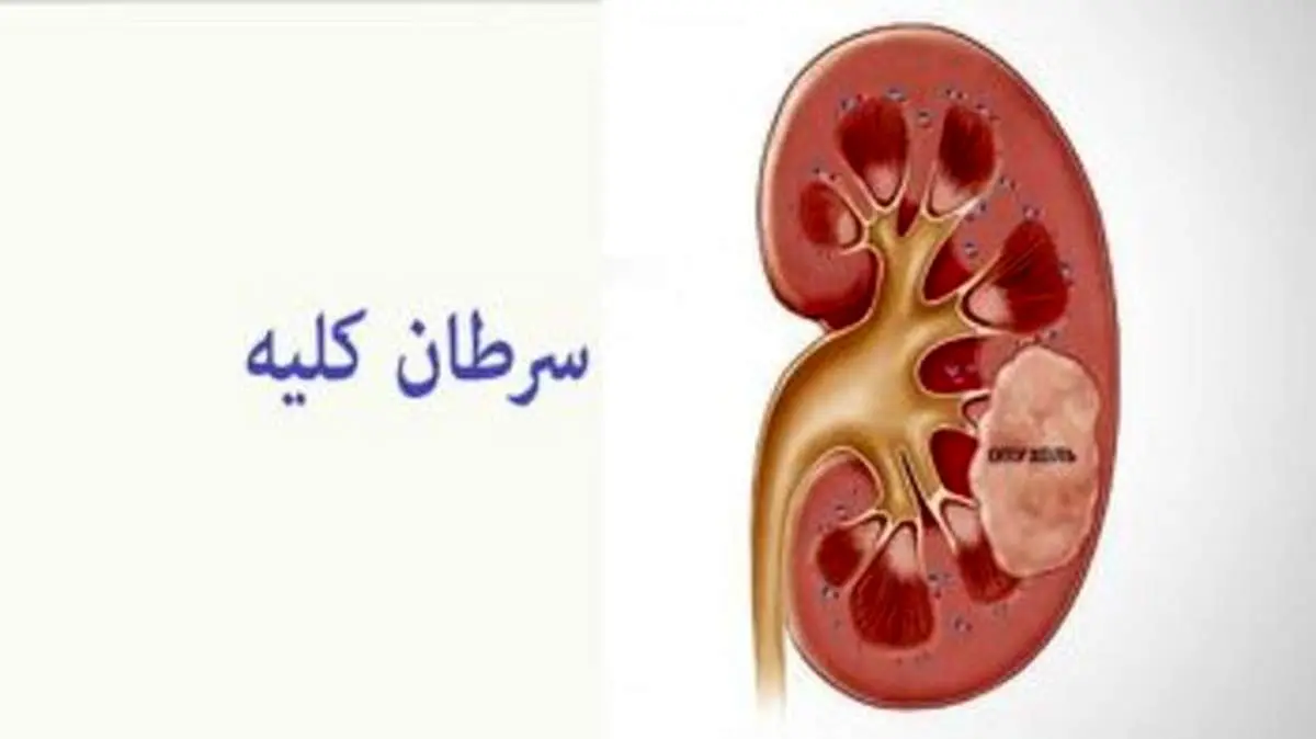 این نشانه‌ها علائم سرطان کلیه است