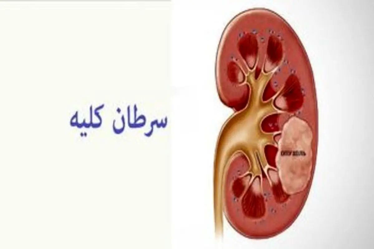 این نشانه‌ها علائم سرطان کلیه است