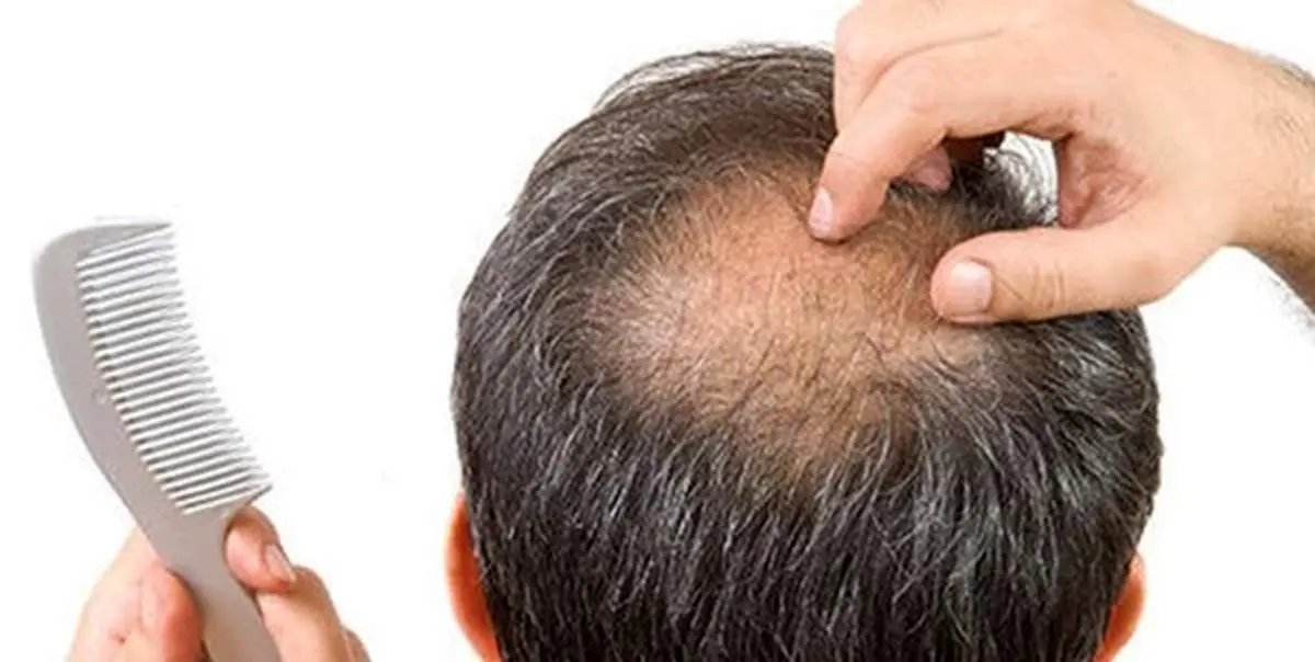 تفاوت ضایعات پوستی و ریزش مو ناشی از کرونا با سایر عوارض پوستی