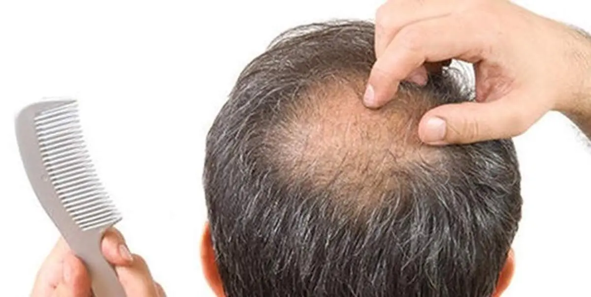 تفاوت ضایعات پوستی و ریزش مو ناشی از کرونا با سایر عوارض پوستی