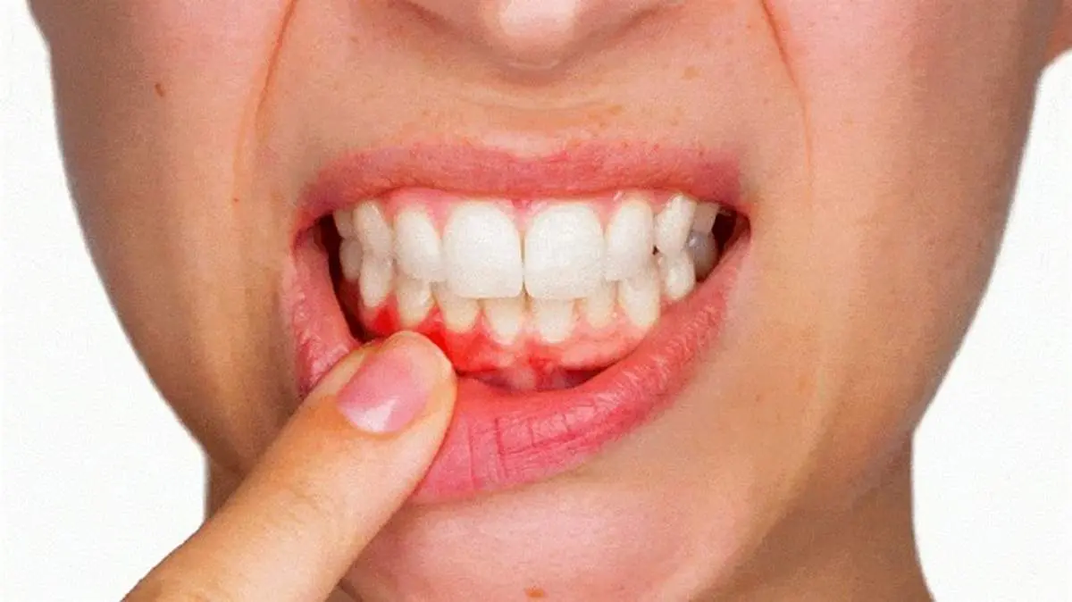 ۸ راهکار خانگی برای از بین بردن تورم لثه