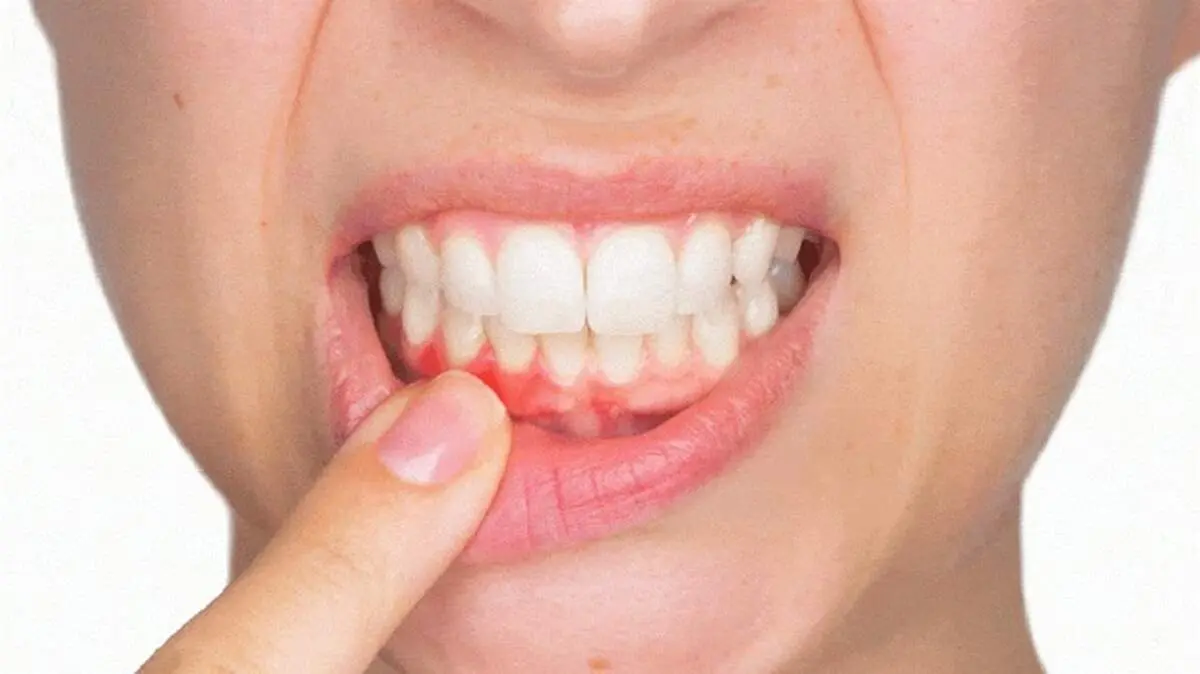 ۸ راهکار خانگی برای از بین بردن تورم لثه