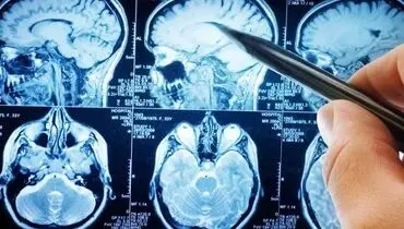 علائم بروز سکته مغزی خاموش چیست؟