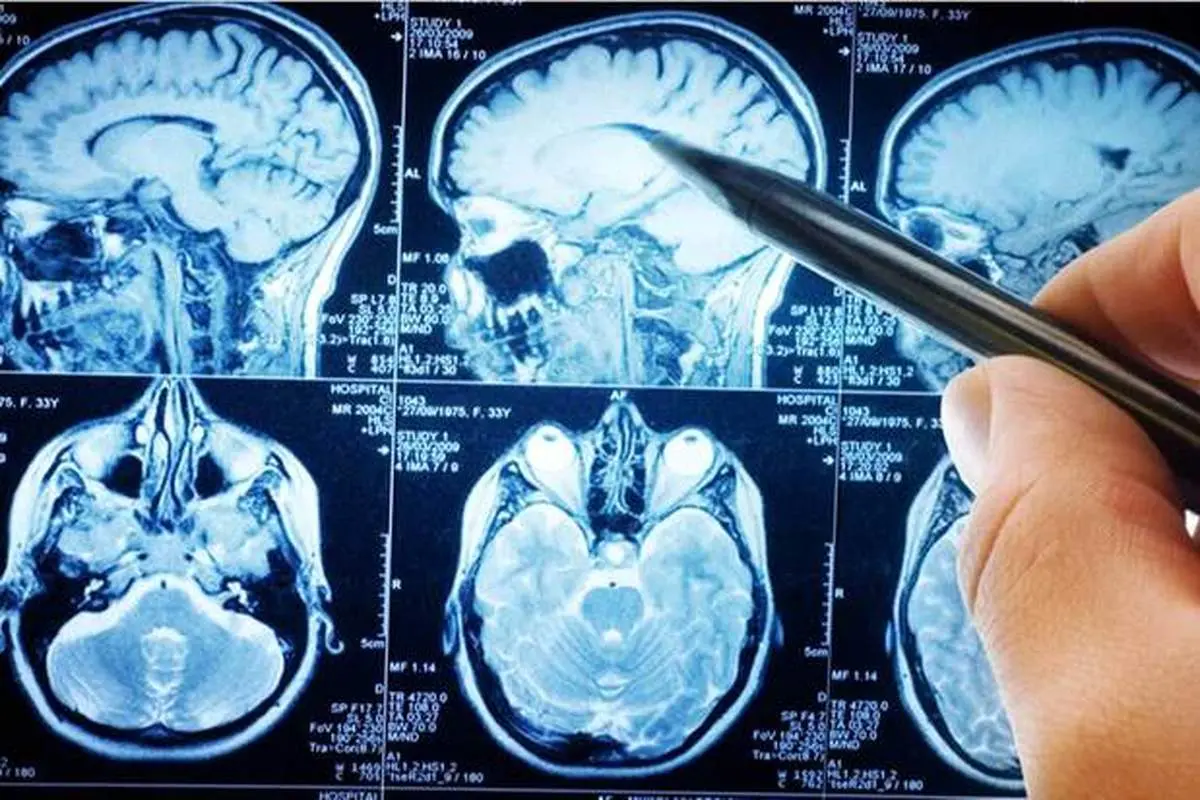 علائم بروز سکته مغزی خاموش چیست؟
