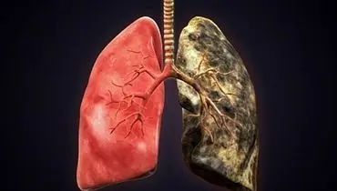 علائم ابتلا به سرطان ریه چیست؟