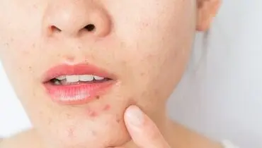 خوراکی هایی که باعث آکنه می شوند
