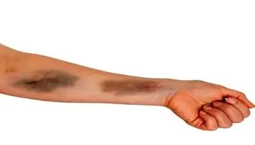 هشدار درباره خود به خود کبود شدن بدن