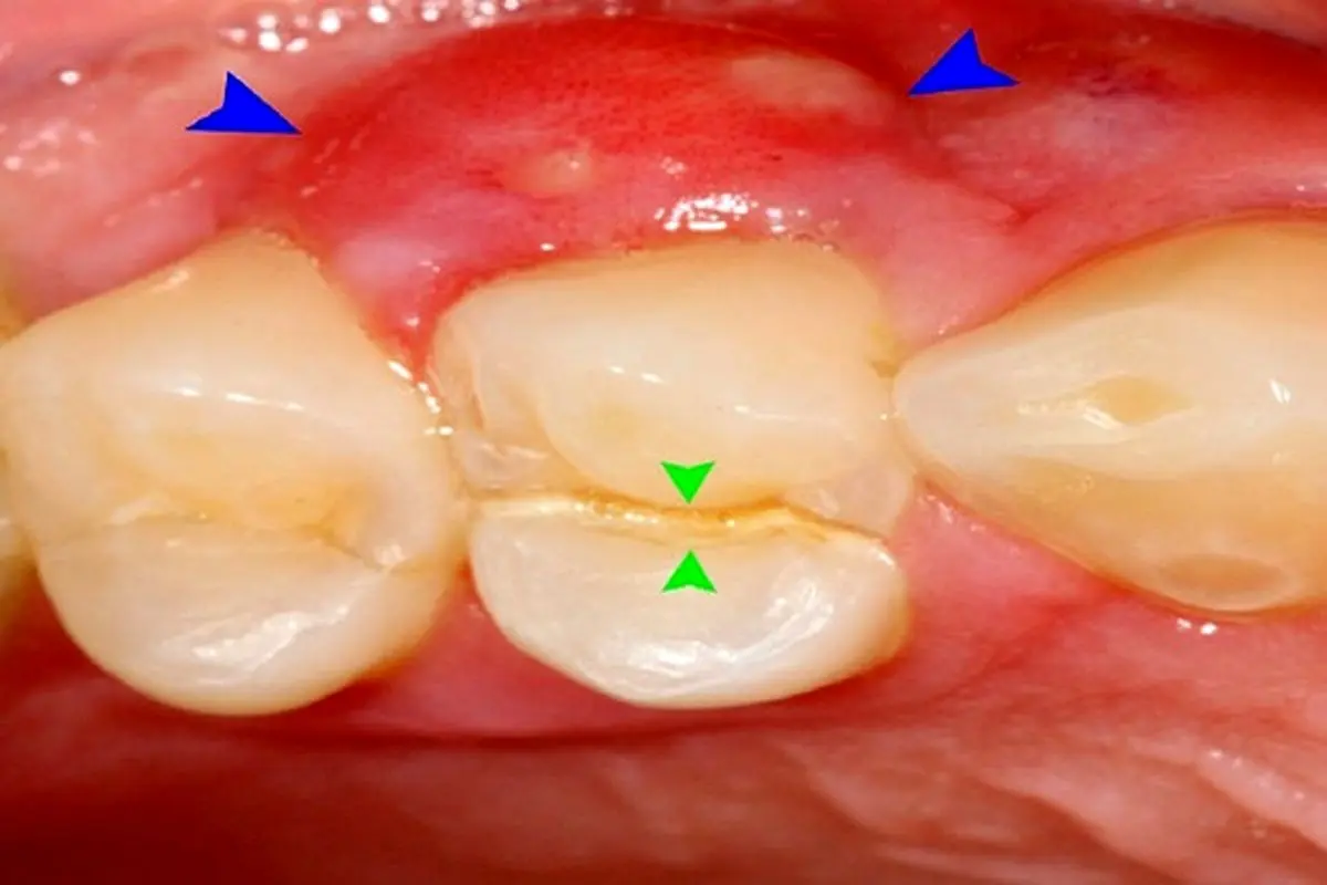 اصلی‌ترین دلیل آبسه دندان چیست؟