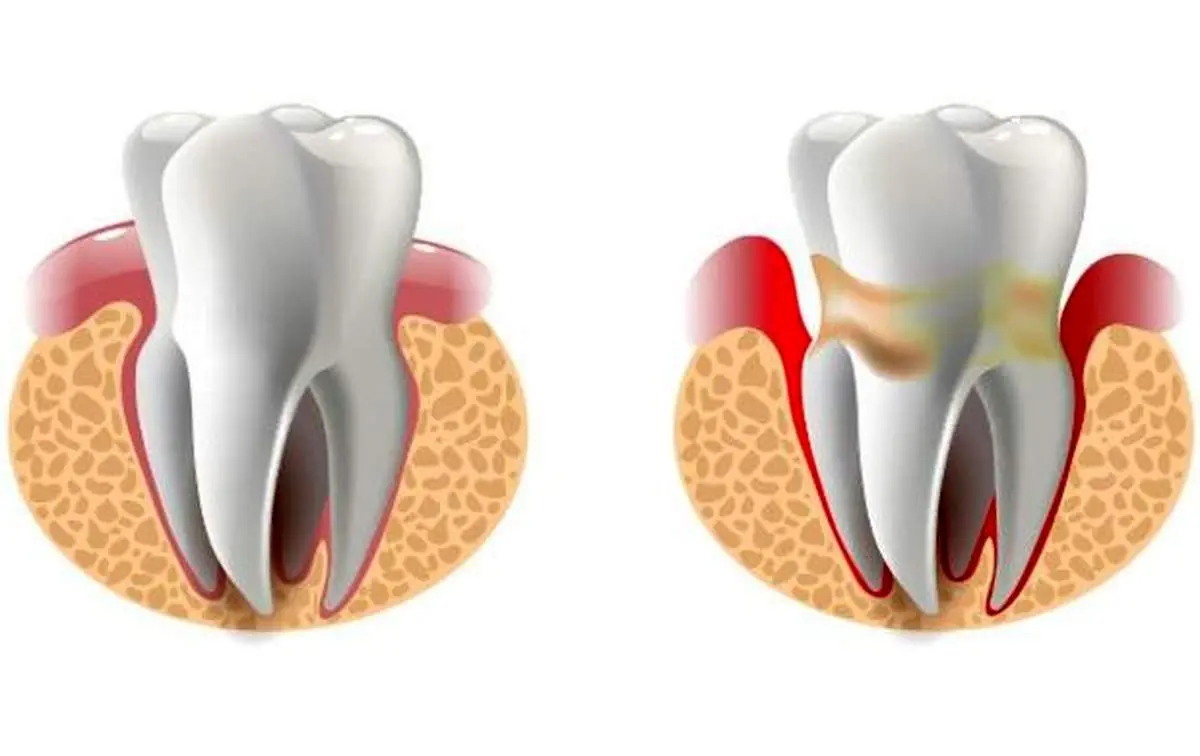 علل توجیه کننده خونریزی لثه ها چیست؟