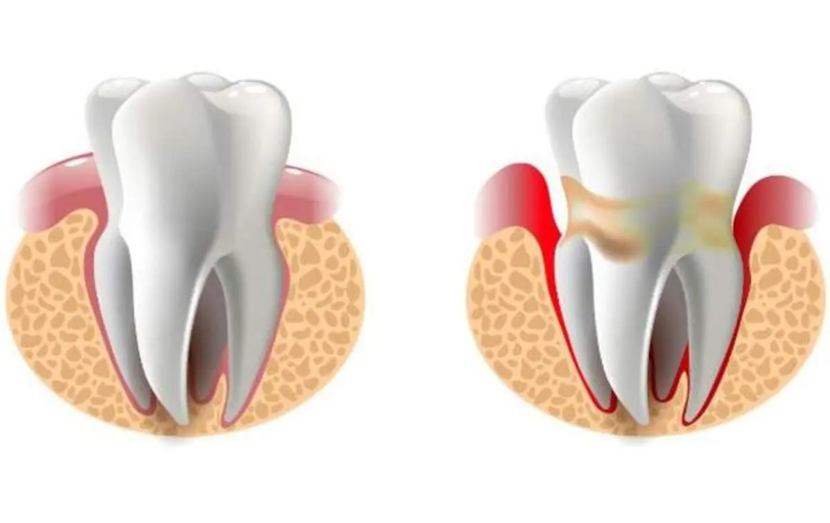 علل توجیه کننده خونریزی لثه ها چیست؟