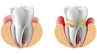 علل توجیه کننده خونریزی لثه ها چیست؟