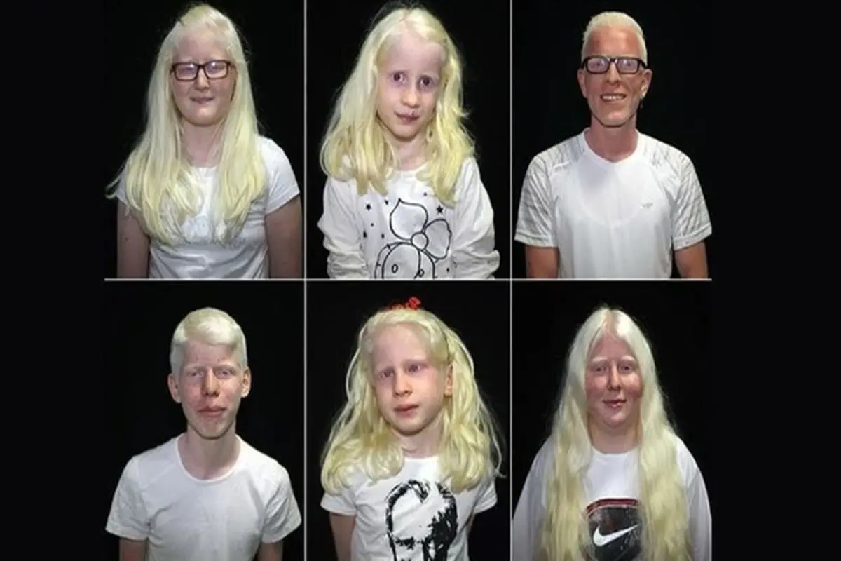 اختلال ژنتیکی که رنگ پوست و مو را تغییر می‌دهد