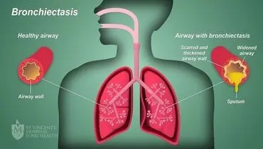 کدام بیماری باعث سرفه خون می شود؟