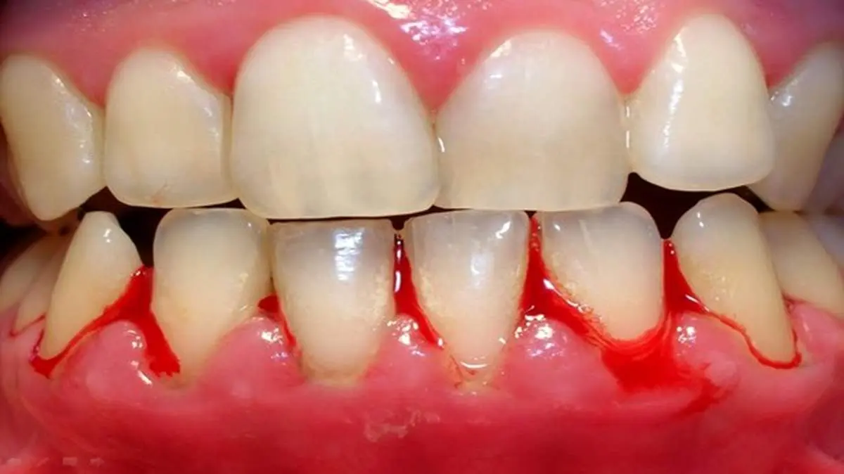 چگونه خونریزی دندان و لثه را متوقف کنیم؟