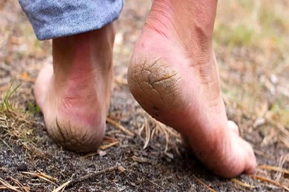 عامل اصلی خشکی پوست دست و پا