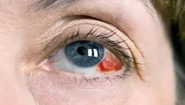 علل لکه های قرمز داخل چشم چیست؟ + روش درمان