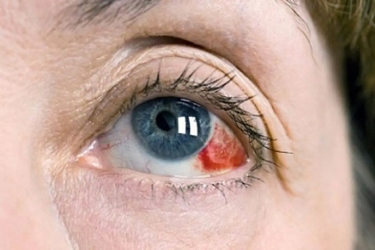 علل لکه های قرمز داخل چشم چیست؟ + روش درمان