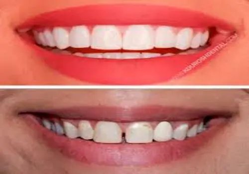 چه اشتباهاتی والدین در مراقبت از دندان‌های کودکان انجام می دهند؟