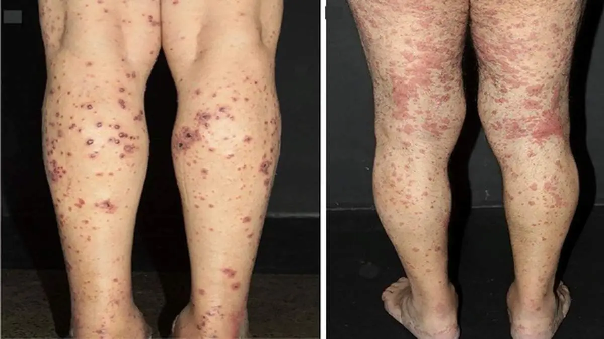 بیماری خود ایمنی که باعث پارگی رگها میشود