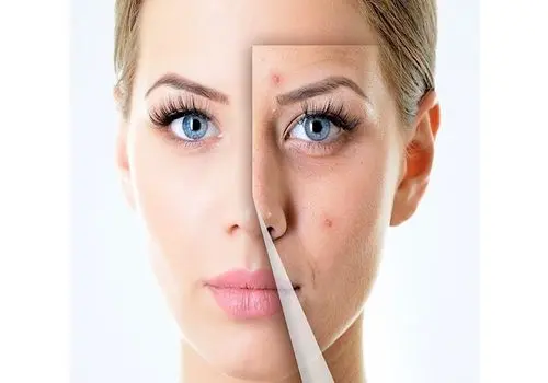 این مواد غذایی خوشمزه باعث بروز آکنه و جوش می‌شوند
