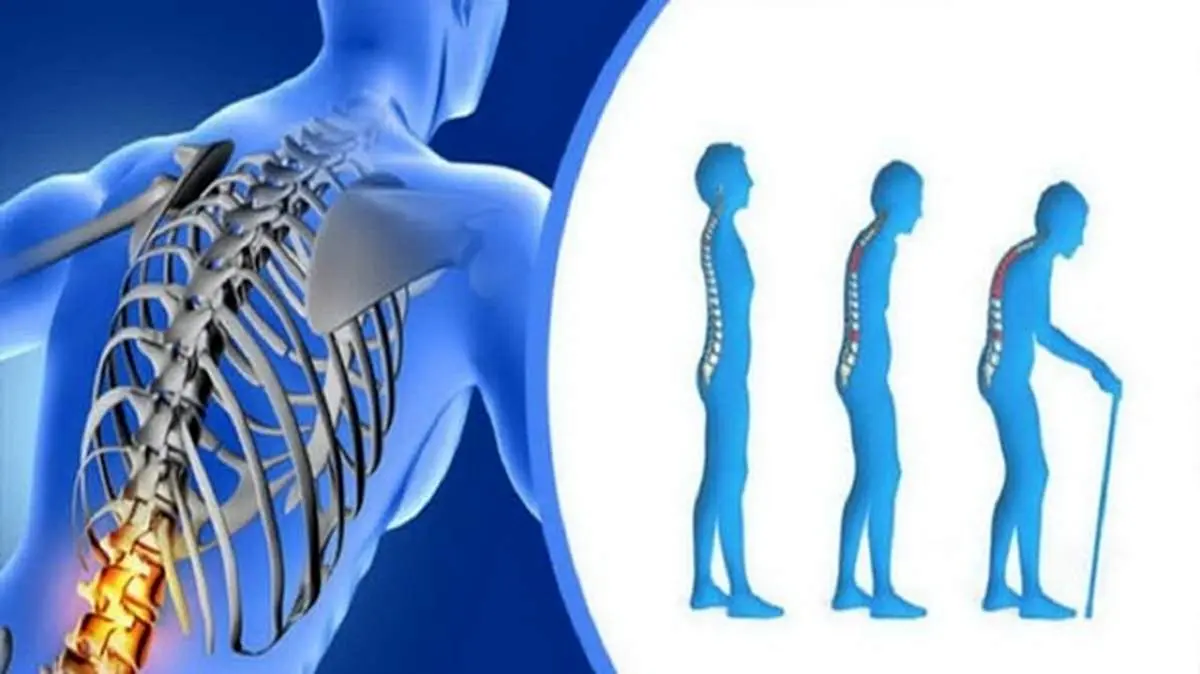 شایع‌ ترین بیماری استخوان و مفاصل
