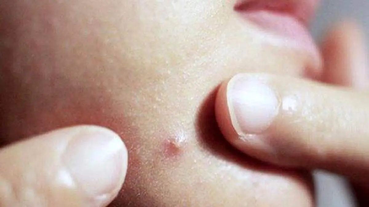 ماسکنه، عارضه ماسک زدن در روزهای کرونایی