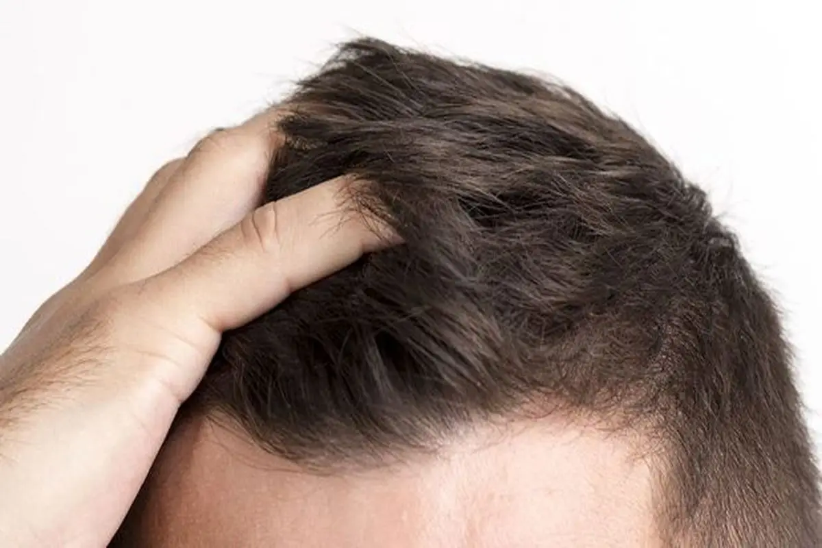 راهکارهای طب سنتی برای جلوگیری از ریزش مو
