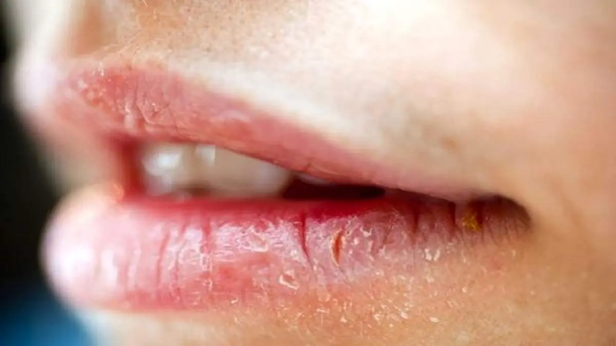 علت ترک خوردن گوشه لب چیست؟