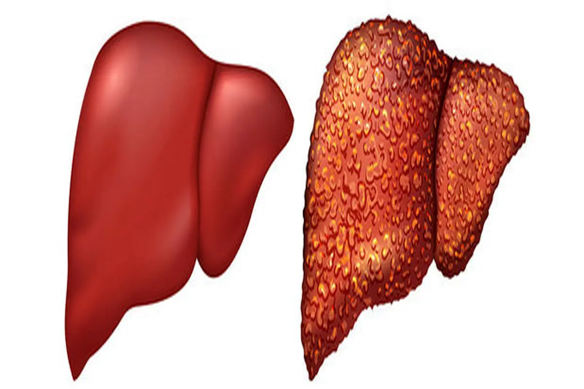 حدود ۸۰ درصد مبتلایان کبد چرب غیرالکلی قبل از مرگ بر اثر سیروز پیشرفته، به علت سکته‌های قلبی و مغزی فوت می‌کنند