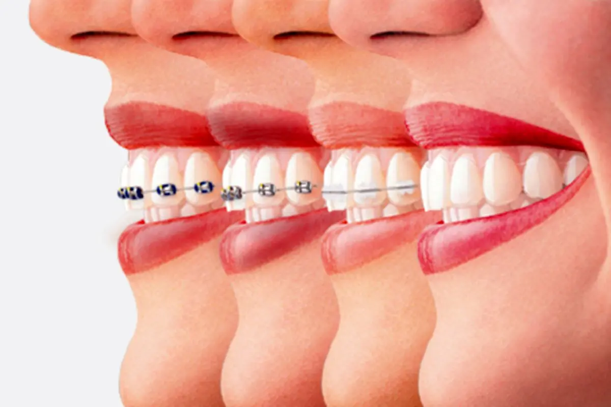 امکان ارتودنسی دندان ها در میانسالی و بزرگسالی