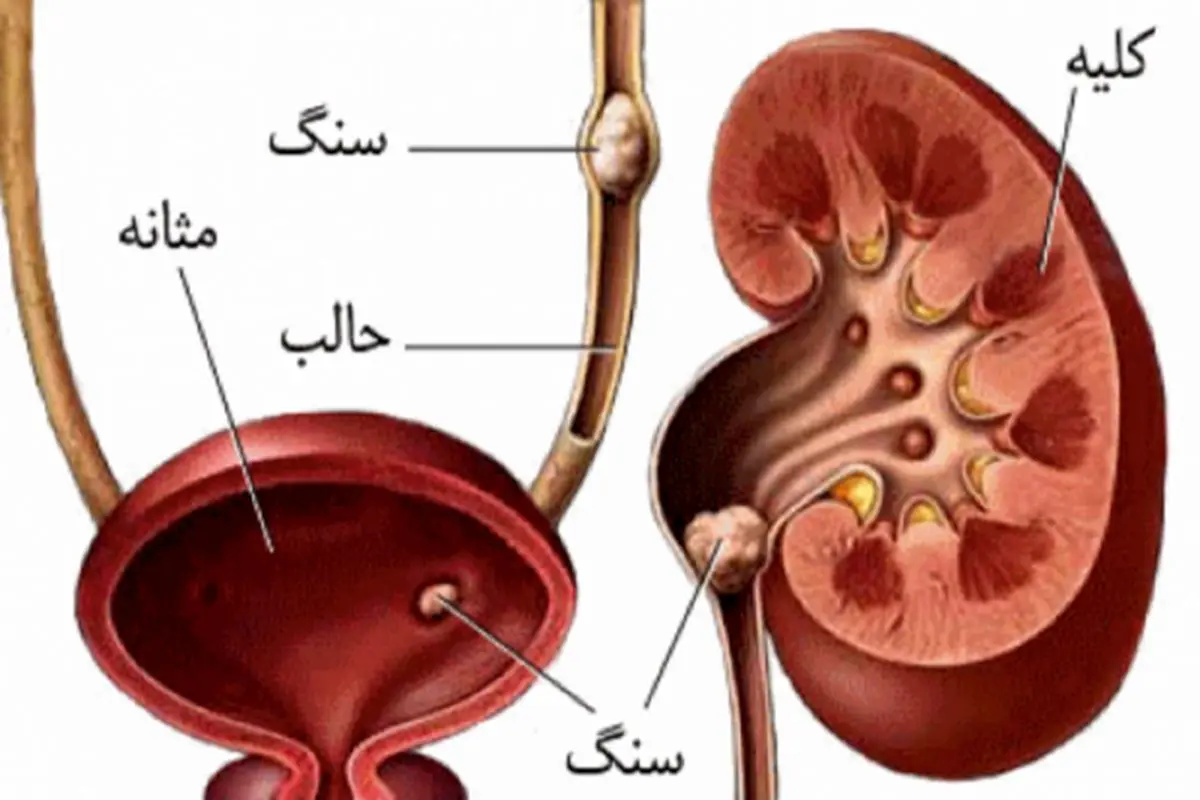 توصیه‌هایی برای پیشگیری از بروز سنگ کلیه