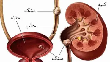 توصیه‌هایی برای پیشگیری از بروز سنگ کلیه